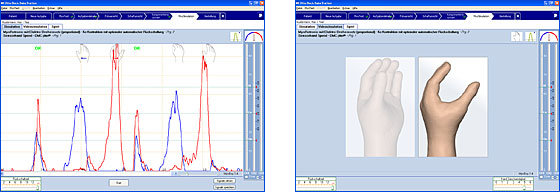 Myoboy used for testing sites for Myoelectric Upper Extremity